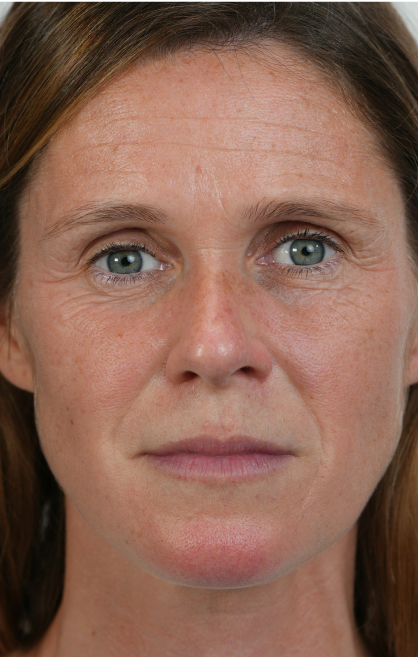 Image d’avant/après